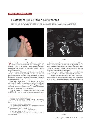 Microembolias distales y aorta peluda - Fac