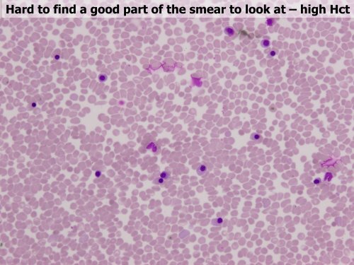 Utility of the peripheral smear and laboratory studies in the ...