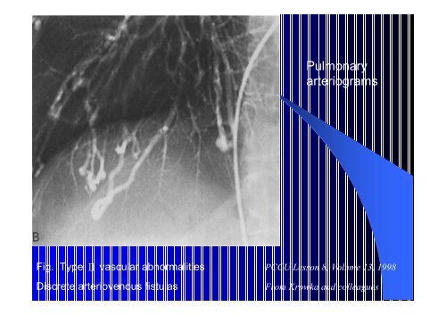 Un inusuale caso di ipossiemia refrattaria