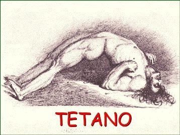 Tetano