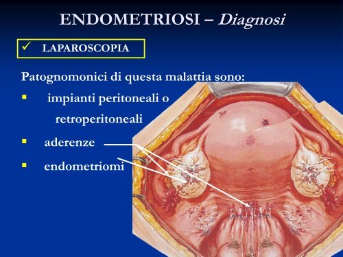 ENDOMETRIOSI – Diagnosi