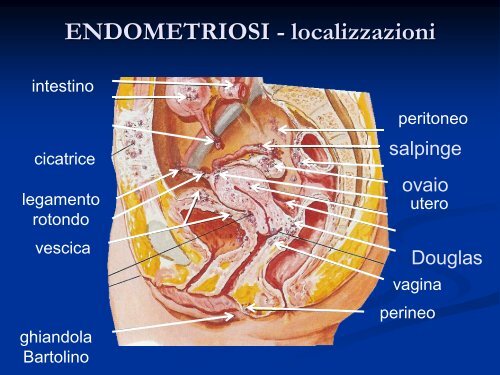 ENDOMETRIOSI – Diagnosi