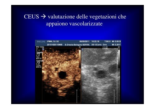 LA CEUS NELLA PATOLOGIA PANCREATICA Carla Serra