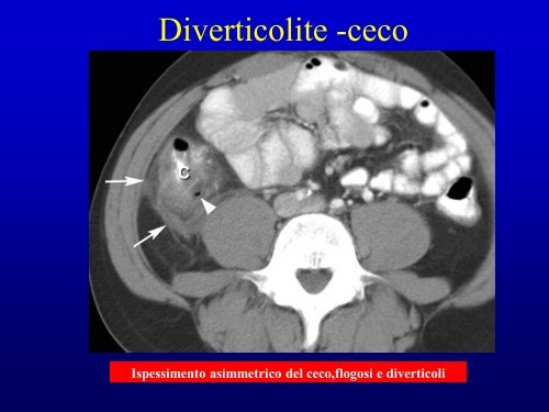 Addome acuto non traumatico