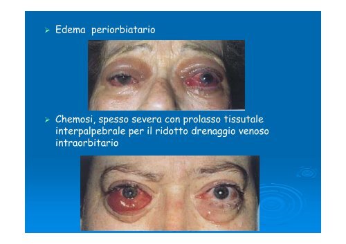 Differenti espressioni dell'oftalmopatia distiroidea - E. Medea