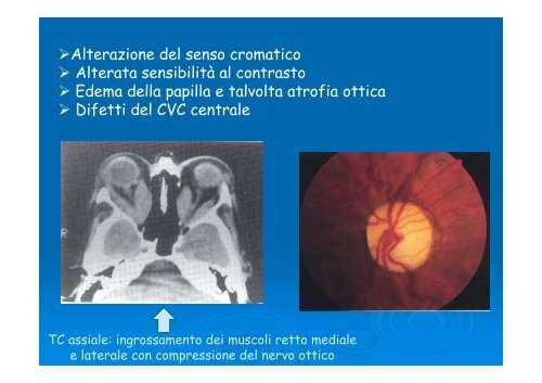 Differenti espressioni dell'oftalmopatia distiroidea - E. Medea