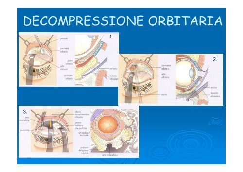 Differenti espressioni dell'oftalmopatia distiroidea - E. Medea