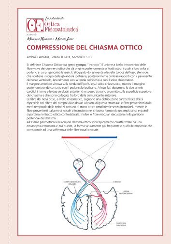 COMPRESSIONE DEL CHIASMA OTTICO - Ottica Fisiopatologica