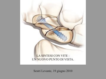 Biomeccanica vite BSS - Chirurgia della mano