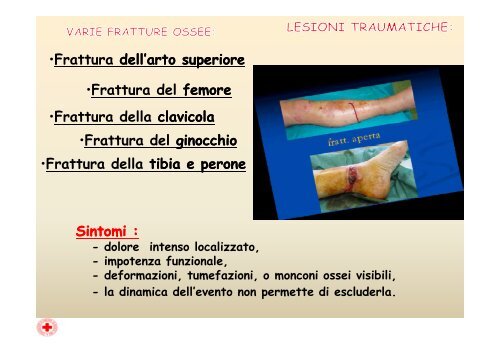 Apparato osseo-tendineo. Fratture distorsioni - Croce Rossa Italiana ...