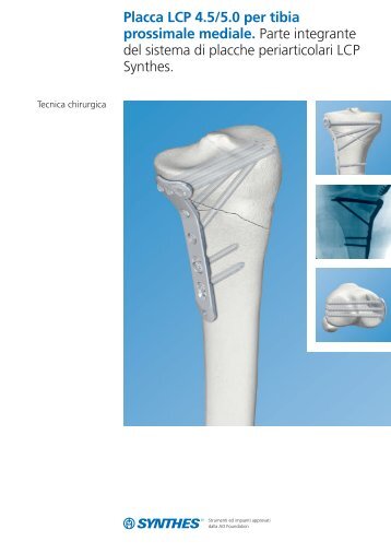 Placca LCP 4.5/5.0 per tibia prossimale mediale. Parte integrante ...