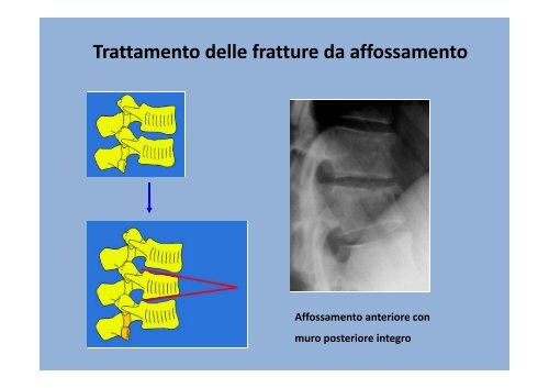 LE FRATTURE VERTEBRALI - Infermieristica Rimini