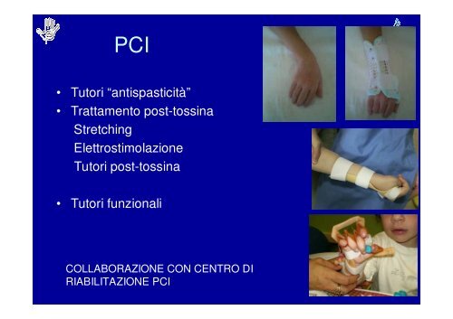 Principi di Riabilitazione della Mano Pediatrica
