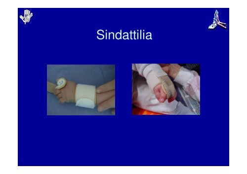 Principi di Riabilitazione della Mano Pediatrica