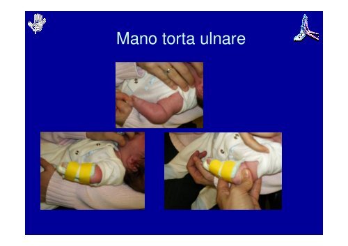 Principi di Riabilitazione della Mano Pediatrica