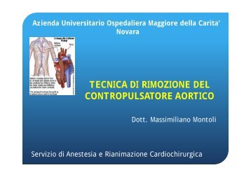 TECNICA DI RIMOZIONE DEL CONTROPULSATORE AORTICO (M ...