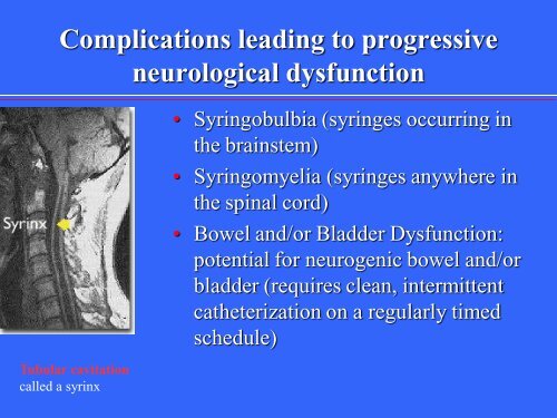 Neural Tube Defects