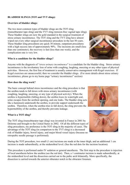 BLADDER SLINGS (TOT and TVT slings) Overview of bladder slings ...