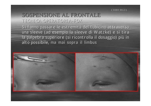 Fibrosi congenita dei muscoli extraoculari - E. Medea