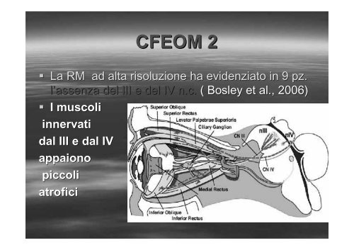 Fibrosi congenita dei muscoli extraoculari - E. Medea