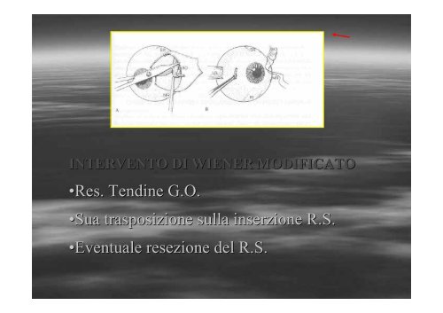 Fibrosi congenita dei muscoli extraoculari - E. Medea