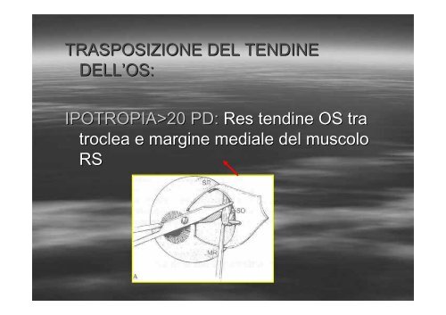 Fibrosi congenita dei muscoli extraoculari - E. Medea