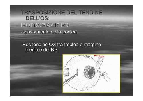 Fibrosi congenita dei muscoli extraoculari - E. Medea