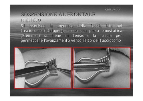 Fibrosi congenita dei muscoli extraoculari - E. Medea