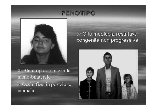 Fibrosi congenita dei muscoli extraoculari - E. Medea