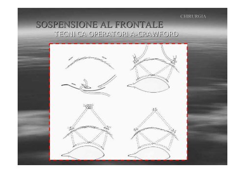 Fibrosi congenita dei muscoli extraoculari - E. Medea