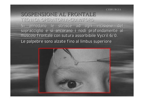 Fibrosi congenita dei muscoli extraoculari - E. Medea