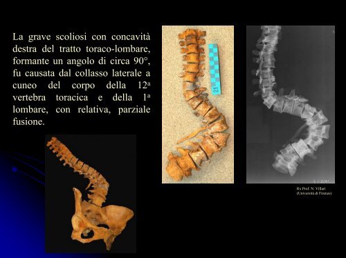 scarica la presentazione - Paleopatologia