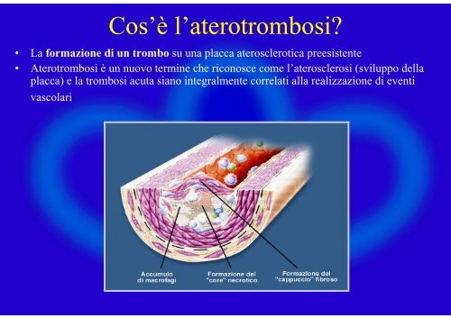 e come si sviluppa l'aterosclerosi - Lega Friulana per il Cuore