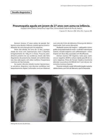 Pneumopatia aguda em jovem de 27 anos com asma na infância.