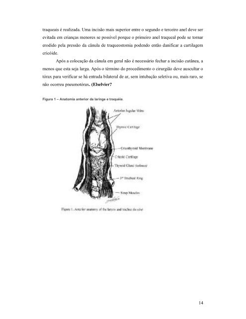 Traqueostomia em crianças - Paulo Roberto Margotto