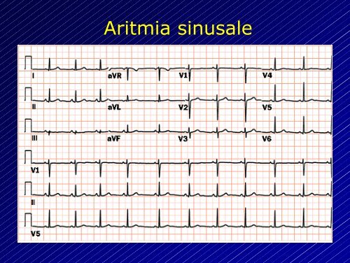 Le aritmie cardiache - Cuorediverona.it