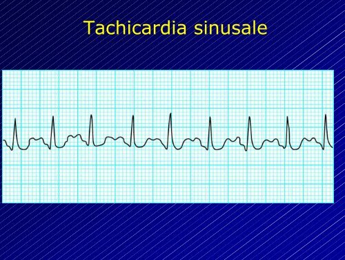 Le aritmie cardiache - Cuorediverona.it