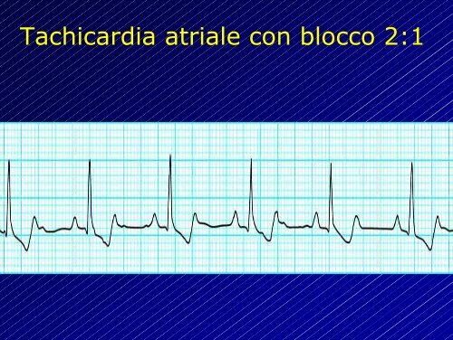 Le aritmie cardiache - Cuorediverona.it