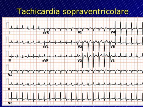 Le aritmie cardiache - Cuorediverona.it