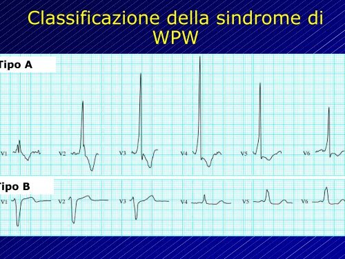 Le aritmie cardiache - Cuorediverona.it