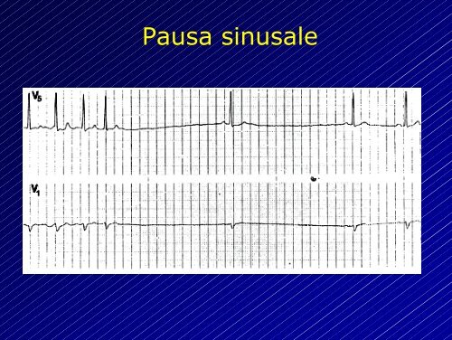 Le aritmie cardiache - Cuorediverona.it