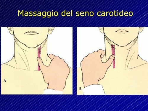 Le aritmie cardiache - Cuorediverona.it