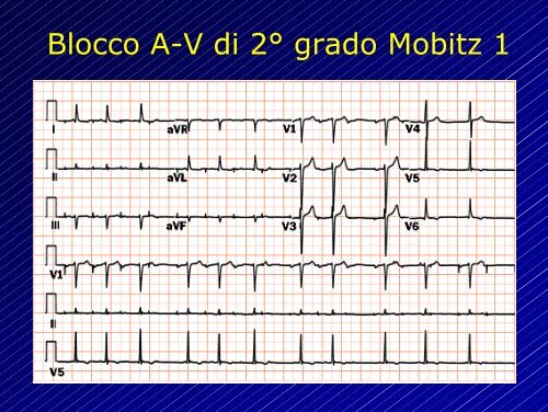 Le aritmie cardiache - Cuorediverona.it