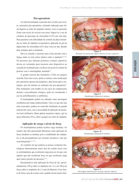 O uso de miniimplantes como auxiliares do tratamento ortodôntico