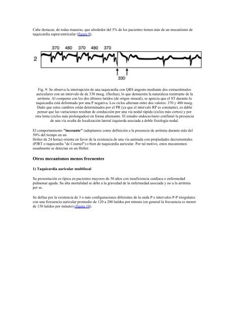 Curso arritmias - G. Zuelgaray: Taquicardias Supraventriculares