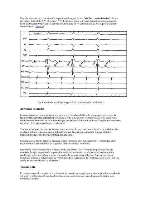 Curso arritmias - G. Zuelgaray: Taquicardias Supraventriculares