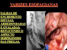 varizes ruins aos 25 anos