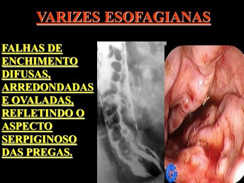 VARIZES ESOFAGIANAS - Comunidades