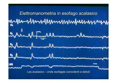 9. Esofago acalasico