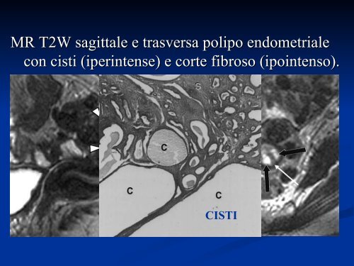 I SANGUINAMENTI UTERINI ANOMALI